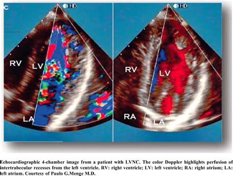 Left Ventricular Noncompaction: New Insights into a Poorly 